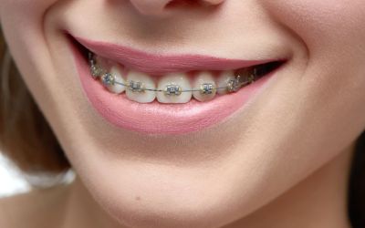 Centra Dental - Top 5 South Houston Braces Maintenance Tips