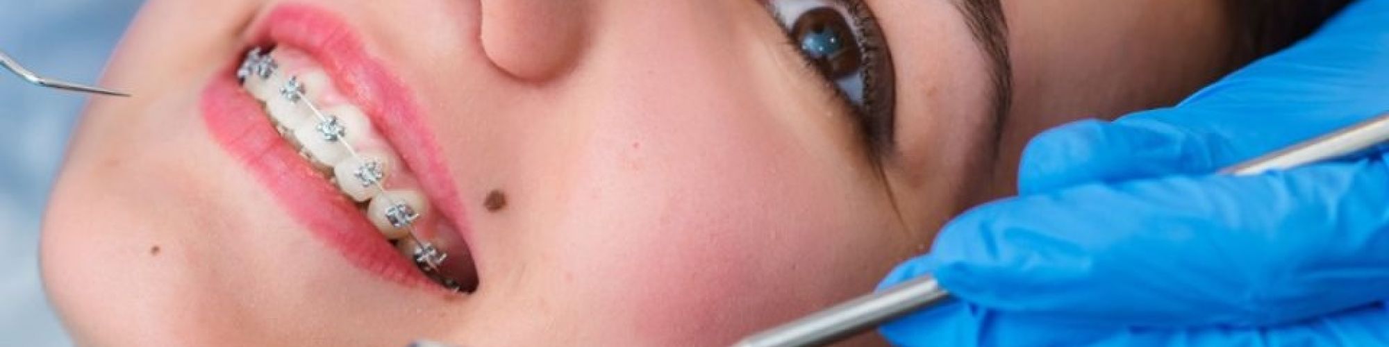 Centra Dental - Reasons to Consider Getting Houston Braces