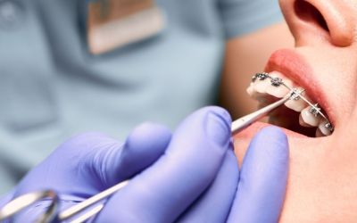 Centra Dental - The Process of Getting South Houston Metal Braces