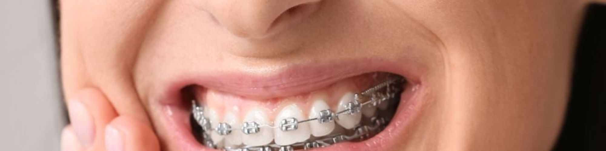 Centra Dental - What to Do About South Houston Braces Pain