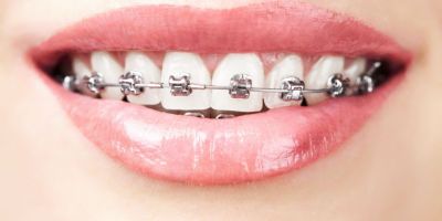 Centra Dental - Different Types of Houston Braces at Our South Houston Family Dentist office