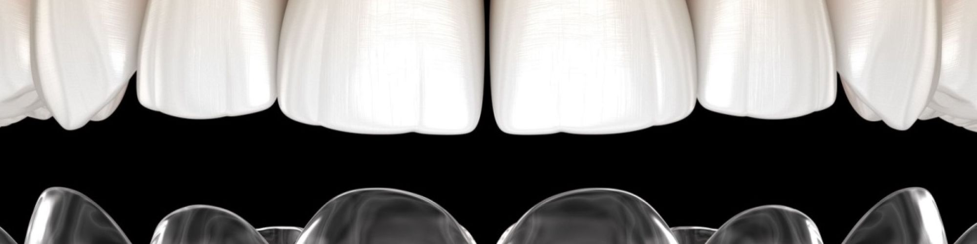 Centra Dental - How Houston Invisalign Braces Work