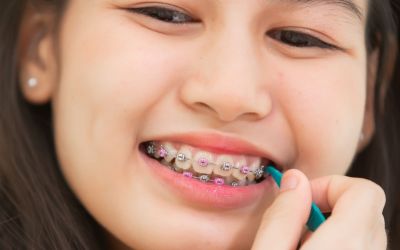 Centra Dental - Daily Habits to Optimize Your South Houston Braces Hygiene