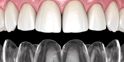 Centra Dental - How Houston Invisalign Braces Work