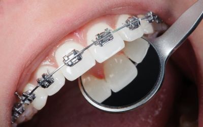 Centra Dental - Adults Should Get Houston Braces, Too