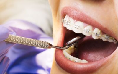 Centra Dental - Houston Braces for Adults