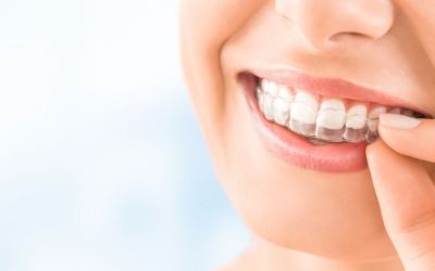 Centra Dental - How To Keep Up Good Hygiene While Wearing Houston Invisalign