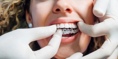 Centra Dental - Is Houston Invisalign Right For You? Get Clear Aligners For $2495