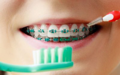 Centra Dental - The Importance of Proper Hygiene and Dental Check-Ups When Wearing South Houston Braces