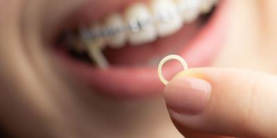 Centra Dental - Do All Houston Braces Patients Need Rubber Bands?