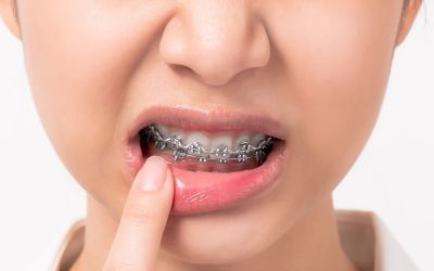 Centra Dental - How to Manage ﻿Houston Braces Pain