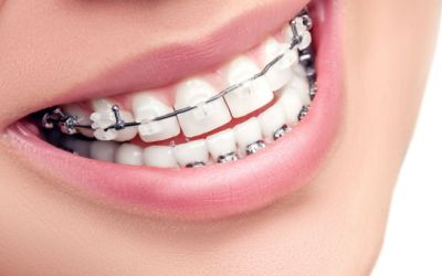 Centra Dental - When to Consider Houston Ceramic Braces for Your Child