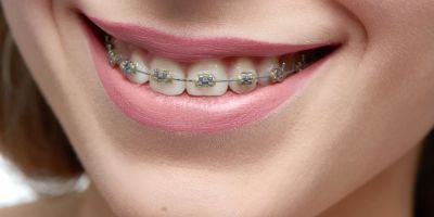 Centra Dental - Top 5 South Houston Braces Maintenance Tips