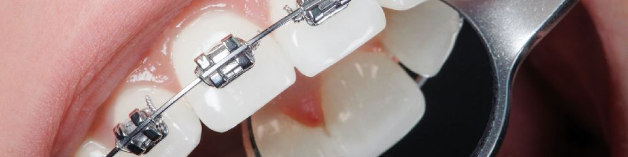 Centra Dental - Adults Should Get Houston Braces, Too