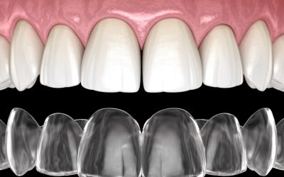Centra Dental - How Houston Invisalign Braces Work