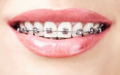 Centra Dental - Different Types of Houston Braces at Our South Houston Family Dentist office