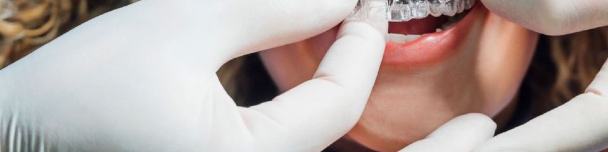 Centra Dental - South Houston Invisalign for Adults