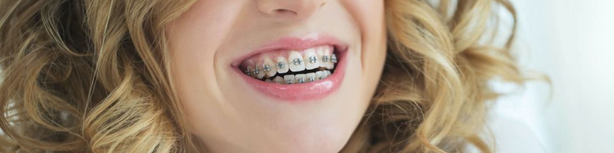 Centra Dental - When Are Metal Houston Braces Recommended