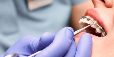 Centra Dental - The Process of Getting South Houston Metal Braces