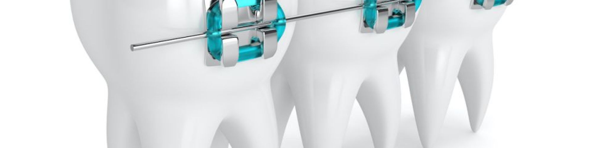 Centra Dental - What To Expect With Metal And Ceramic Houston Braces