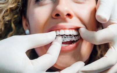 Centra Dental - Is Houston Invisalign Right For You? Get Clear Aligners For $2495