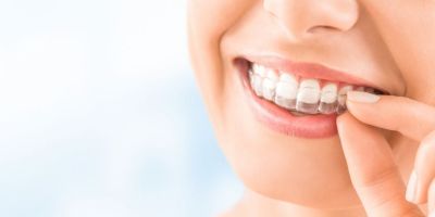 Centra Dental - How To Keep Up Good Hygiene While Wearing Houston Invisalign