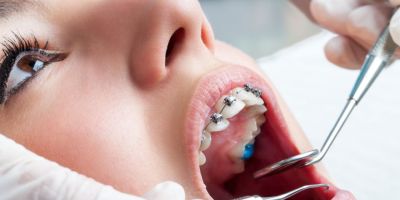 Centra Dental - Early Orthodontics Affected by Lack of Dental Visits
