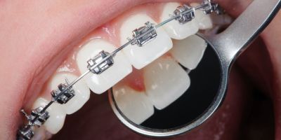 Centra Dental - Adults Should Get Houston Braces, Too