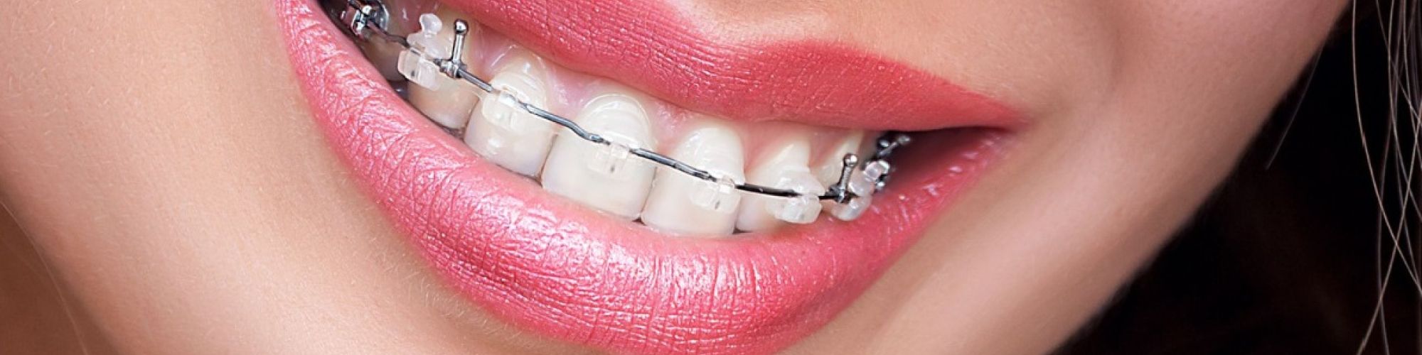 Centra Dental - Ceramic South Houston Braces versus Metal Braces
