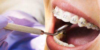 Centra Dental - Houston Braces for Adults
