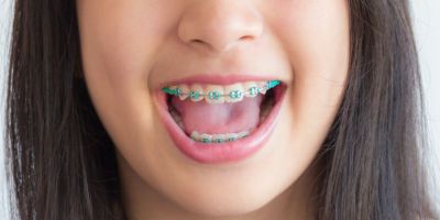 Centra Dental - Houston Metal Braces For Children