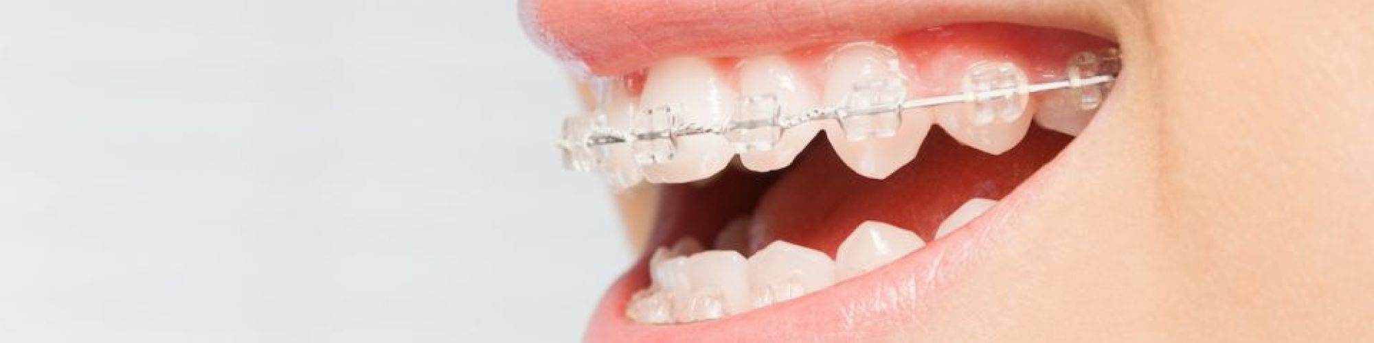 Centra Dental - Ceramic Houston Braces for Adults