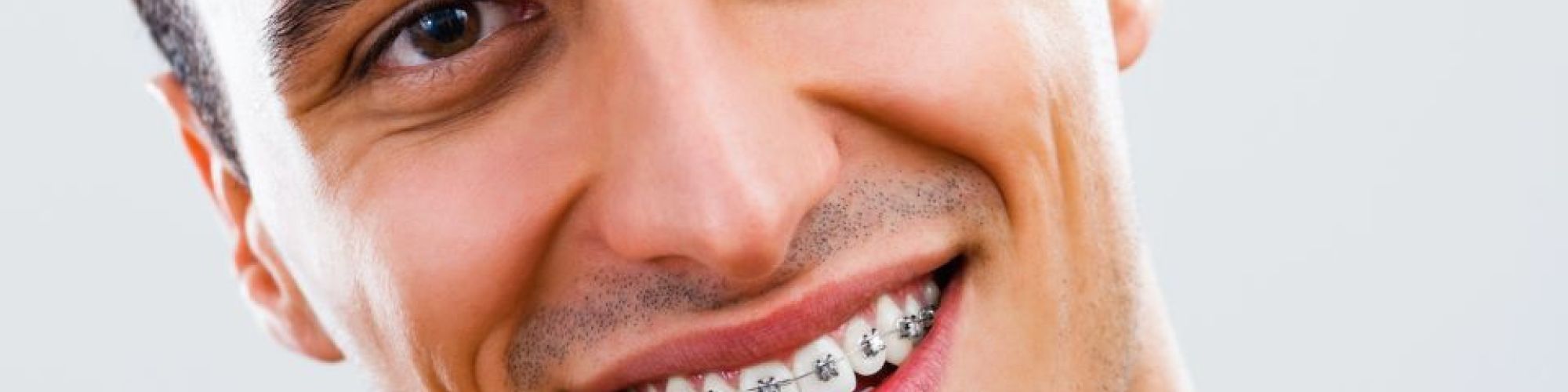 Centra Dental - Keeping Your Teeth Clean While Wearing Houston Braces