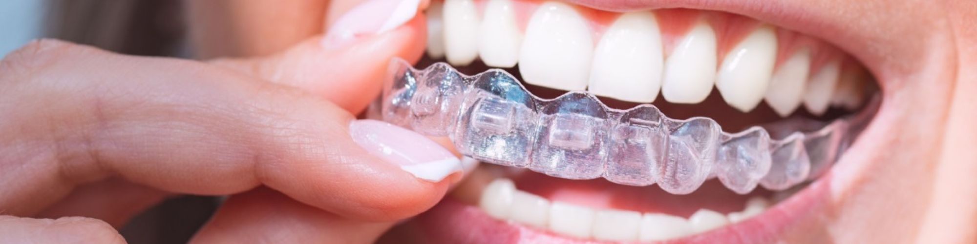 Centra Dental - Different Types of Retainers to Wear After Houston Braces