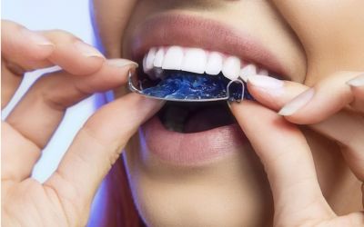 Centra Dental - What Happens After You Get Your South Houston Braces Off? Tips on Maintaining Your New Smile