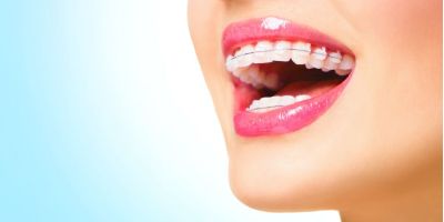 Centra Dental - When Our South Houston Family Dentists Recommend Ceramic Houston Braces