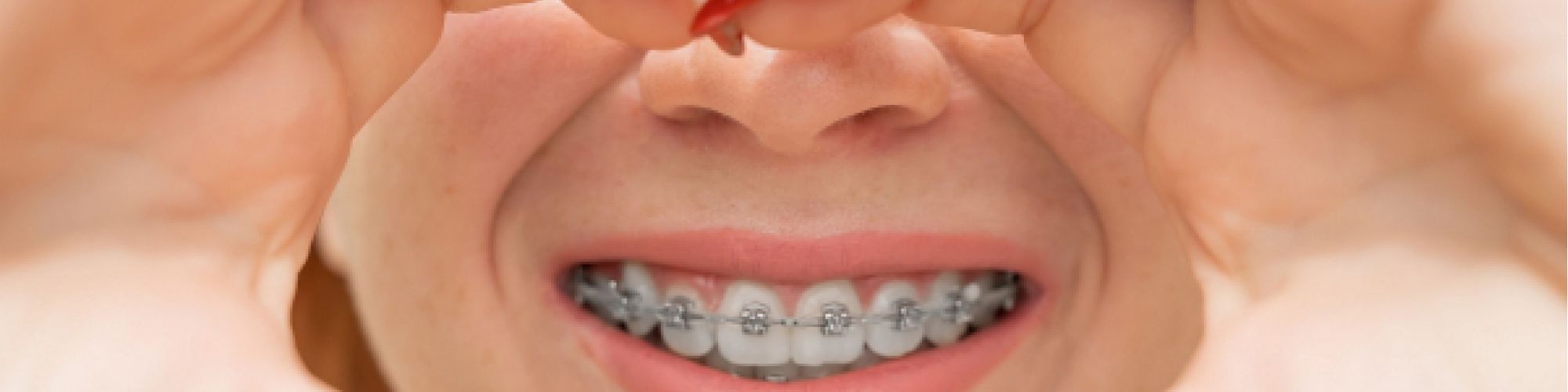 Centra Dental - How to Choose the Right Type of South Houston Braces for You