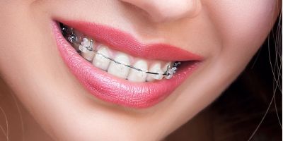 Centra Dental - Ceramic South Houston Braces versus Metal Braces