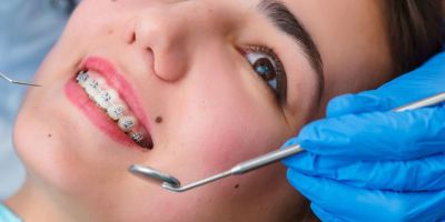 Centra Dental - Reasons to Consider Getting Houston Braces