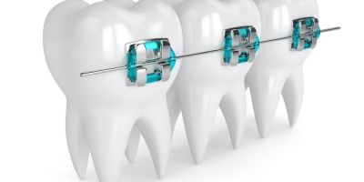 Centra Dental - What To Expect With Metal And Ceramic Houston Braces