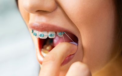 Centra Dental - Why Wearing Your Elastics With Houston Braces Is a Must