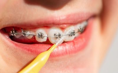 Centra Dental - How to Keep Your Teeth Clean While Wearing Houston Braces