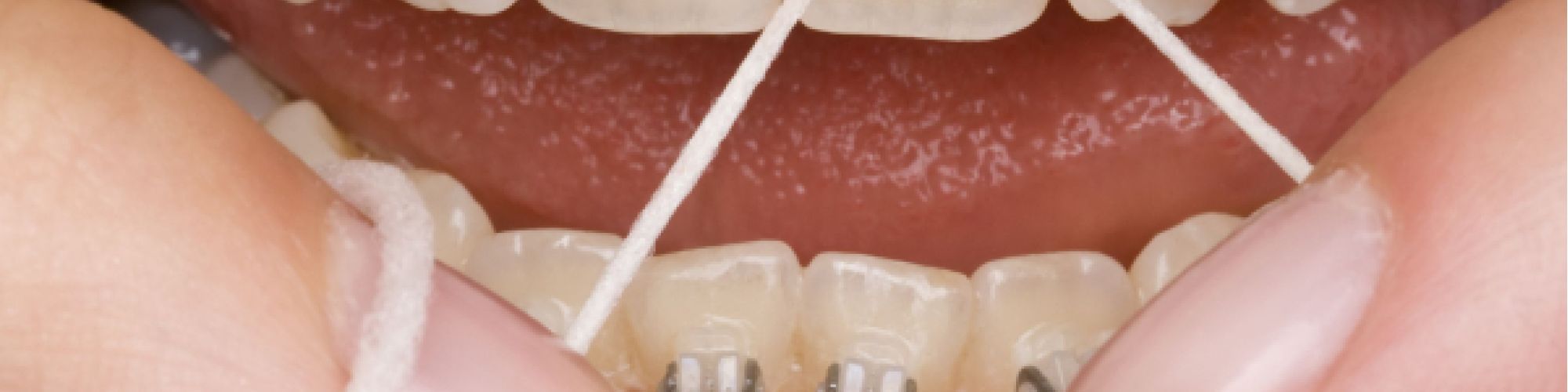 Centra Dental - Maintaining Oral Hygiene with Metal Houston Braces
