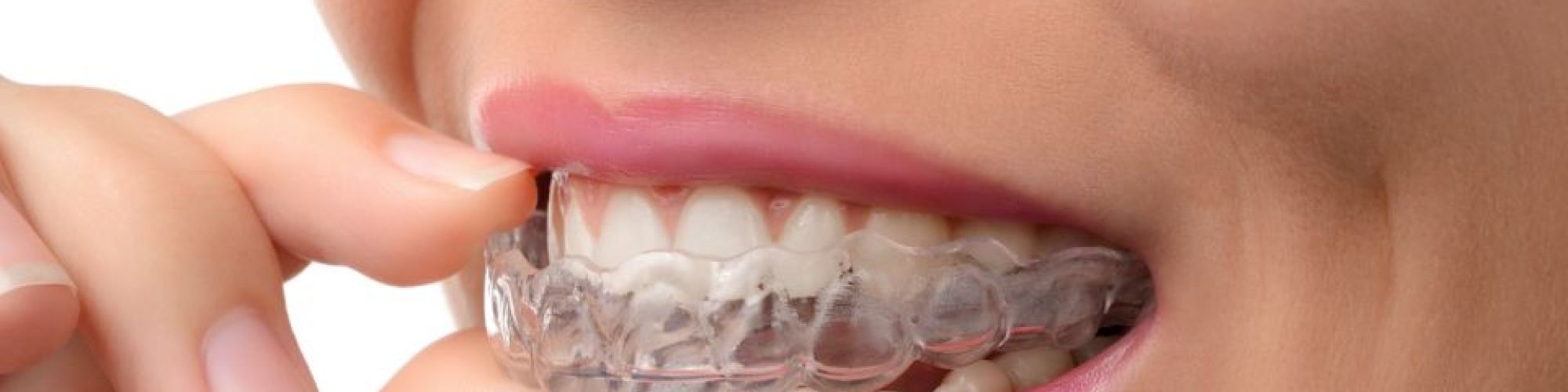 Centra Dental - Wearing South Houston Invisalign Instead Of Metal Braces