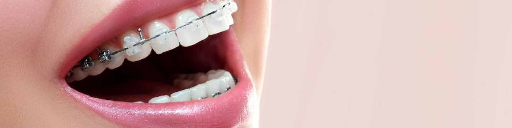 Centra Dental - Ceramic Houston Braces Versus Metal Dental Braces