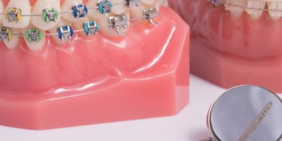 Centra Dental - Ceramic Houston Braces Versus Metal Braces