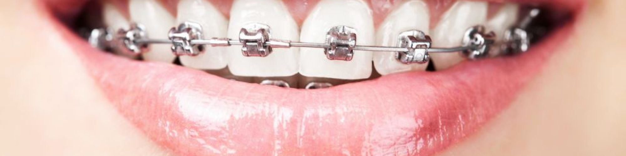 Centra Dental - Different Types of Houston Braces at Our South Houston Family Dentist office