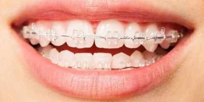 Centra Dental - Maintain Your South Houston Invisalign Smile With Clear Retainers