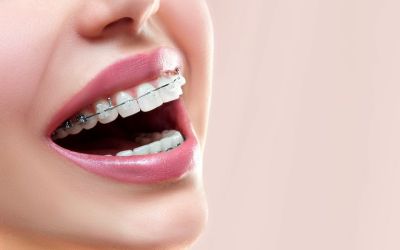 Centra Dental - Ceramic Houston Braces Versus Metal Dental Braces