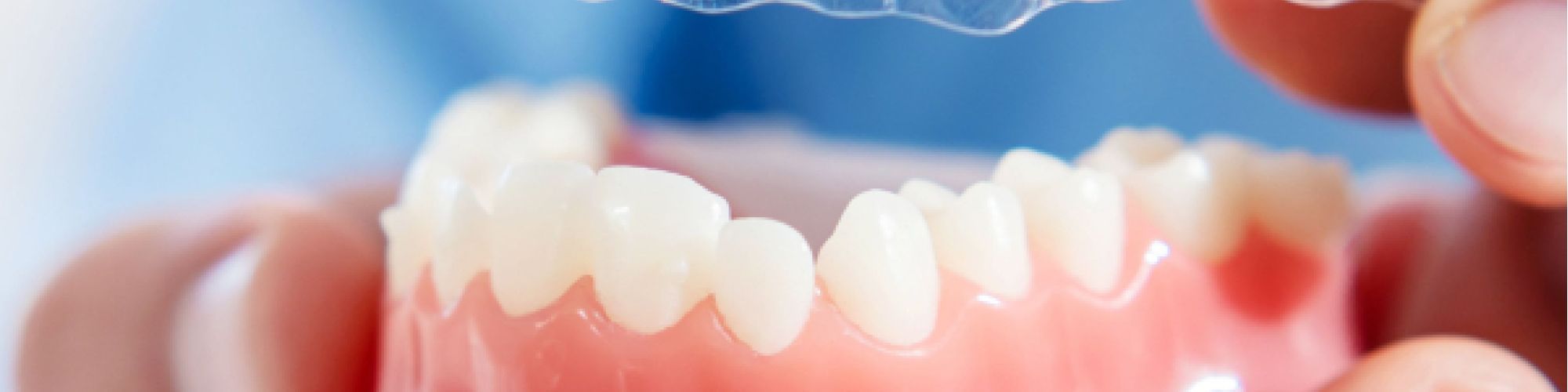 Centra Dental - Who Is a Candidate for Houston Invisalign?